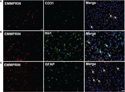 Extracellular matrix metalloproteinase inducer in brain ischemia and intracerebral hemorrhage
